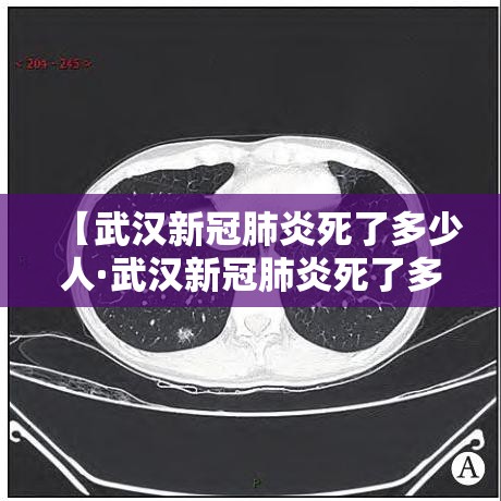 【武汉新冠肺炎死了多少人·武汉新冠肺炎死了多少人口】
