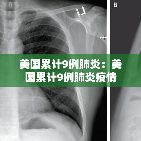 美国累计9例肺炎：美国累计9例肺炎疫情